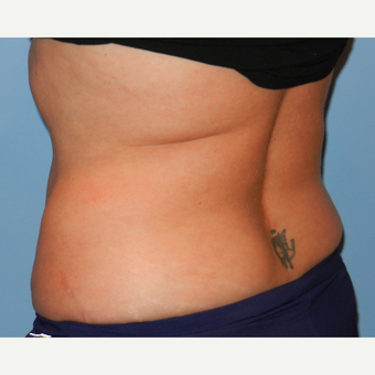 35-44 year old woman treated with CoolSculpting after 3748663
