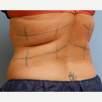 35-44 year old woman treated with CoolSculpting before 3748663