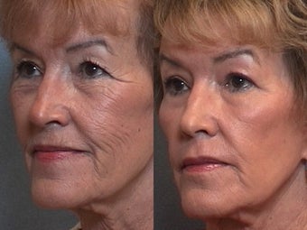 Woman Treated for Wrinkles Without Doing A Face LIft before 1271509
