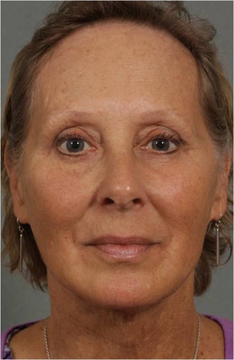 62 year old female with loss of facial volume contributing to sagging along her neck and jaw line after 983622