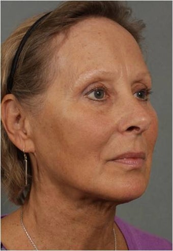 62 year old female with loss of facial volume contributing to sagging along her neck and jaw line 983622