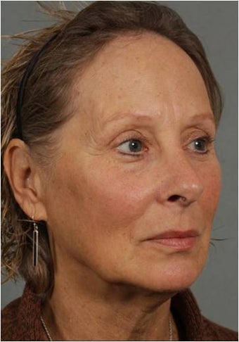 62 year old female with loss of facial volume contributing to sagging along her neck and jaw line 983622