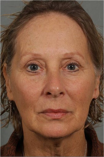 62-year-old-female-with-loss-of-facial-volume-contributing-to-sagging