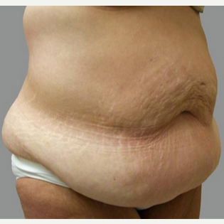 Woman treated with Body Lift before 1809142