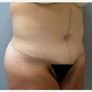 Woman treated with Body Lift after 1809142