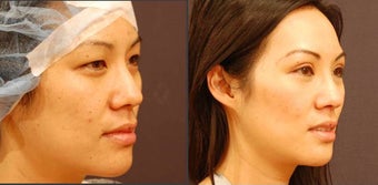 Asian Eyelid Surgery before 523920