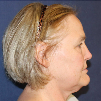 55-64 year old woman treated with Facelift before 3714678