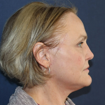 55-64 year old woman treated with Facelift after 3714678