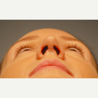 18-24 year old woman treated with Rhinoplasty after 3417503