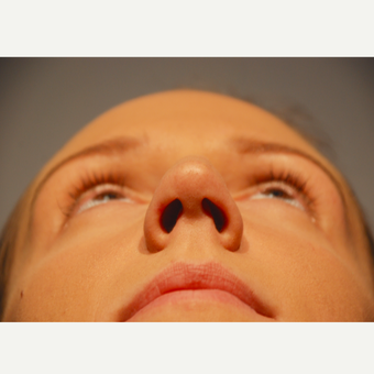 18-24 year old woman treated with Rhinoplasty before 3417503