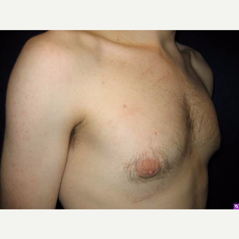 18-24 year old man treated with Male Breast Reduction after 3711758