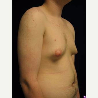 18-24 year old man treated with Male Breast Reduction before 3711758