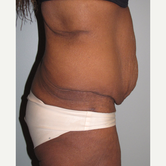 55-64 year old woman treated with Panniculectomy after 3691291