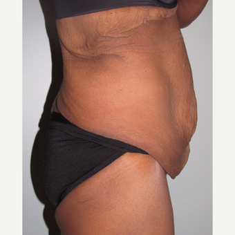 55-64 year old woman treated with Panniculectomy before 3691291