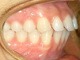 Invisalign 890230
