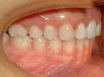 Invisalign 890230