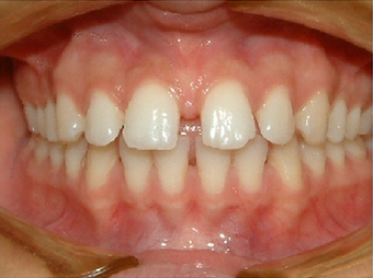 Invisalign before 890230