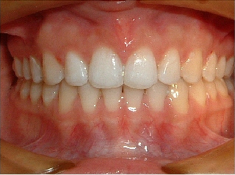 Invisalign after 890230