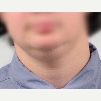 18-24 year old man treated with Chin Liposuction before 3719106