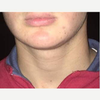 18-24 year old man treated with Chin Liposuction after 3719106