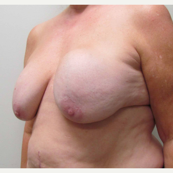 Breast Implant Revision for this 58 Year Old Woman before 3043296