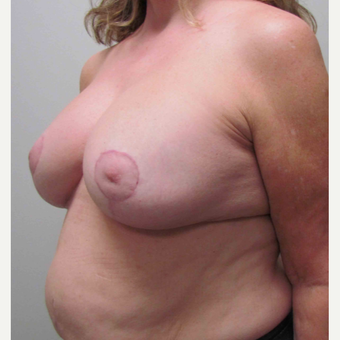 Breast Implant Revision for this 58 Year Old Woman after 3043296