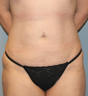 35-44 year old woman treated with Liposuction after 3589571