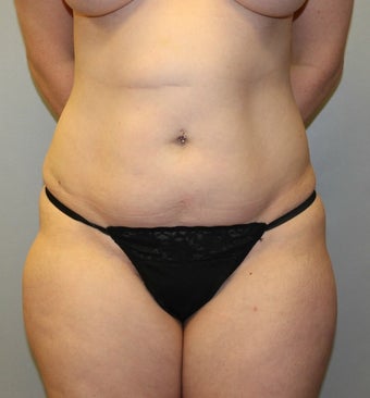 35-44 year old woman treated with Liposuction before 3589571