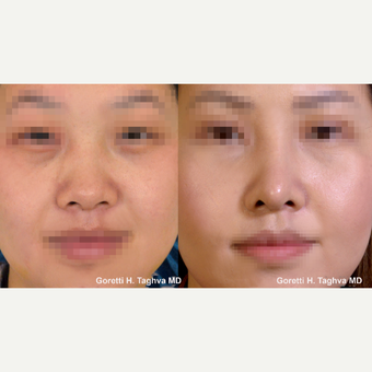 25-34 year old woman treated with DC-F (diced cartilage-fascia) Asian Rhinoplasty before 3038376