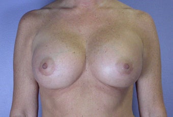 45-54 year old woman treated with Breast Augmentation after 3278105