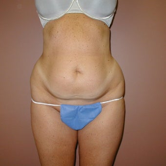 38 year old woman treated with Tummy Tuck before 1971055