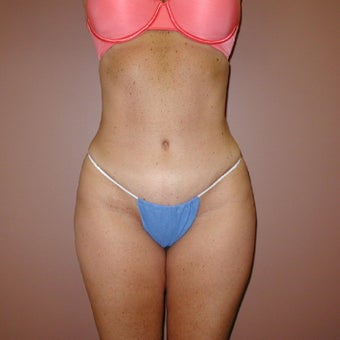 38 year old woman treated with Tummy Tuck after 1971055