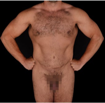 35-44 year old man treated with Body Jet after 3220634