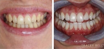Enlighten Teeth Whitening before 3093759