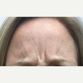 35-44 year old woman treated with Wrinkle Treatment before 3802052