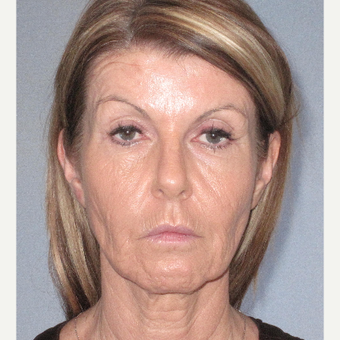 45-54 year old woman treated with Facelift before 3364644