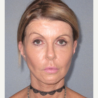 45-54 year old woman treated with Facelift after 3364644