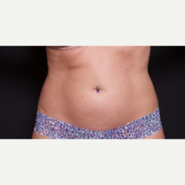 35-44 year old woman treated with SculpSure to abdomen and love handles after 3646507
