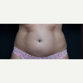 35-44 year old woman treated with SculpSure to abdomen and love handles before 3646507