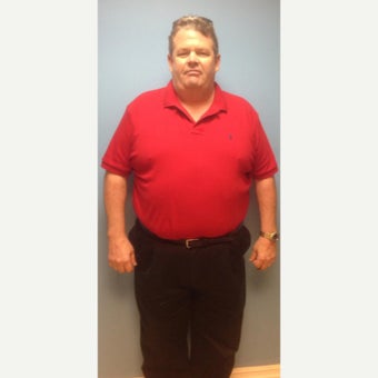 45-54 year old man treated with Sleeve Gastrectomy before 2661316