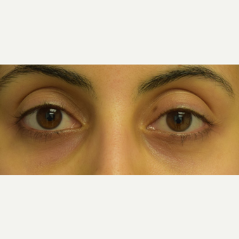 25-34 year old woman treated with Restylane to correct lower eyelid asymmetry after 3642223