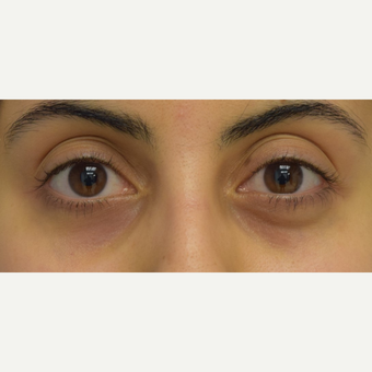 25-34 year old woman treated with Restylane to correct lower eyelid asymmetry before 3642223