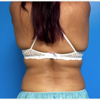 35-44 year old woman treated with CoolSculpting after 3612012