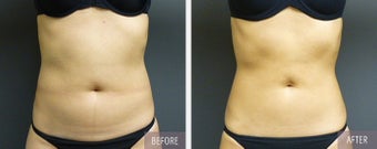 CoolSculpting before 1263118
