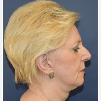 65-74 year old woman treated with MACS Facelift before 3332221