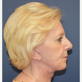 65-74 year old woman treated with MACS Facelift after 3332221