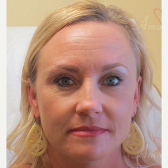 35-44 year old woman treated with Voluma in cheeks before 3368906