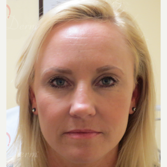 35-44 year old woman treated with Voluma in cheeks after 3368906