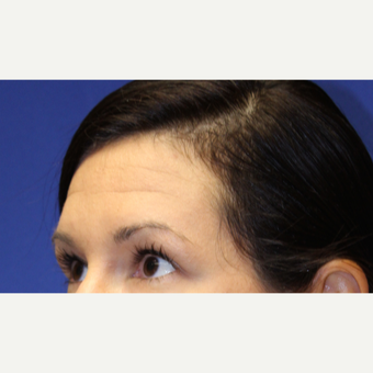 32 year old woman treated with Botox before 3737393