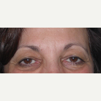 55-64 year old woman treated with Eyelid Surgery before 3070052